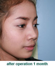 plastic_surgery_augmentation_rhinoplasty